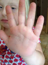 Check spelling or type a new query. Hands Palmar Creases In Children With Down S Syndrome Future Of Down S