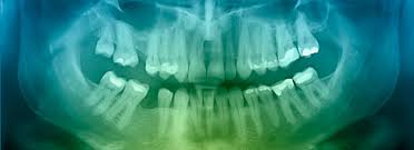 Here are some tips to help prevent cavities. What Is The Color Of A Cavity Delta Dental Of Washington