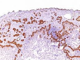 The epithelial related antigen (moc31), epcam (berep4), etc., . Webpathology Com A Collection Of Surgical Pathology Images
