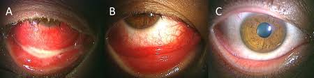 Image result for Gonococcal Conjunctivitis