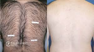 Using either laser or surgery or combination of both. Laser Hair Removal Men Pulse Light Clinic London