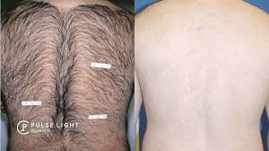 The hair on your butt does serve a purpose; Laser Hair Removal Men Pulse Light Clinic London