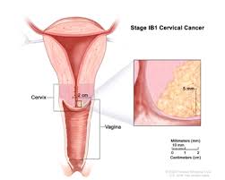 Often, there are no problems until the cancer is advanced and has spread. Cervical Cancer Treatment Pdq Treatment Patient Information Nci Cs Mott Children S Hospital Michigan Medicine