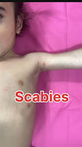 Image result for scabies human children