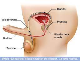 It should be independent of what instrument is used for the surgery.) Retrograde Ejaculation Medically Speaking