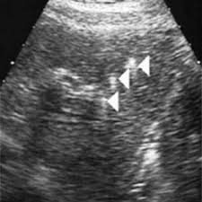 Pdf Low Phospholipid Associated Cholelithiasis Association With Mutation In The Mdr3 Abcb4 Gene