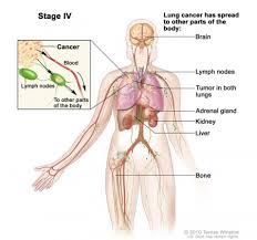 The symptoms tend to develop as the cancer spreads and. Lung Cancer Physiopedia