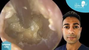 GNARLY INFECTION! 346 #ear #earwax #earwaxremoval #asmrearwax #satisfying  #foryou #fyp #foryourpage