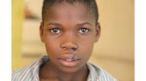 Cleft Mission to Zimbabwe