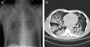 Mrsa strains are further characterized as superbugs because mrsa. Mrsa As A Cause Of Lung Infection Including Airway Infection Community Acquired Pneumonia And Hospital Acquired Pneumonia European Respiratory Society