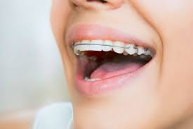 After a certain period of time, most patients switch to the use of a removable retainer. Retainers Cream Ridge Orthodontics