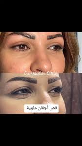 قص أجفان علوية بعد أسبوع من العمل الجراحي, بدون ألم بدون ندبة #latakia🇸🇾  #syria🇸🇾 #damas #plasticsurgery #lipsfillers💋 #rhinoplasty  #bleopharoplasty