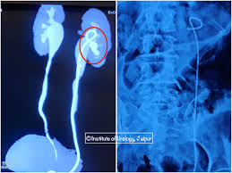 Image result for Nephrolithiasis Imaging