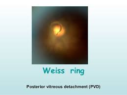 Rings Dots Lines Spots Optometry Education Optometry Eye Health