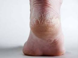 Sore that doesn't heal after seven to. 10 Diseases Your Feet Can Reveal Microsoft News