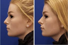 Liquid Rhinoplasty