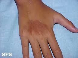 Image result for Photodermatitis
