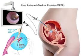 fetoscopic endoluminal tracheal occlusion feto to treat