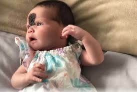 Parents forced to go private as baby born with birthmark refused facial  surgery