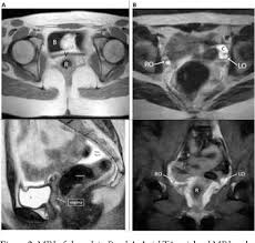 Upper portion of vagina/lower proton of the urogenital sinus) Pdf Mullerian Agenesis Presenting As An Isolated Rudimentary Uterus Semantic Scholar