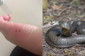 Image result for Snake Bite