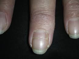 Image result for Muehrcke Line