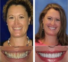 Contact us for your next . Cosmetic Dentistry In San Diego Ca Hornbrook Center For Dentistry