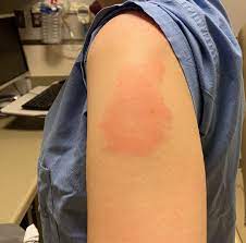 You may have heard about some delayed skin reactions to the moderna shot. Covid Vaccine Side Effects Study Rashes Skin Reactions Not Dangerous