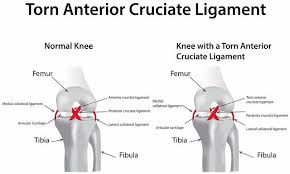 We did not find results for: What Is Anterior Cruciate Ligament Acl Injury Symptoms Reasons