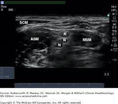 Image result for Superior Trunk Block