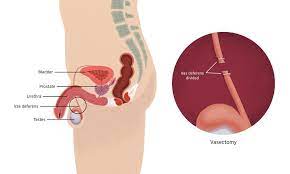 Vasectomy Doctors Australia