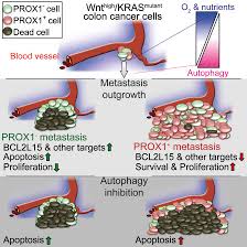Doctors aren't certain what causes most colon cancers. Prox1 Promotes Metabolic Adaptation And Fuels Outgrowth Of Wnthigh Metastatic Colon Cancer Cells Sciencedirect