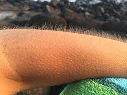 You must have felt goosebumps when a cool breeze brushed past your skin or while you were watching an exciting thriller! Scientists Discovered The Real Reason Behind Goosebumps Tech Explorist