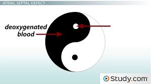 Septal Defects Of The Heart Definition Conditions And Symptoms