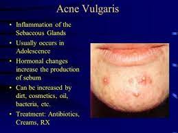 Pin On Sebaceous Glands
