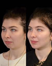 1 month after chin implant placement and this beautiful 25 year old's  facial profile has been transformed 💫 She can't stop smiling…and neither  can we! Goals of Surgical Chin Augmentation: