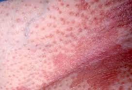 Check spelling or type a new query. Pityriasis Rubra Pilaris And Variants Devergie S Disease Lichen Acuminatus Lichen Psoriasis Lichen Ruber Acuminatus Lichen Ruber Pilaris Pityriasis Pilaris Dermatology Advisor
