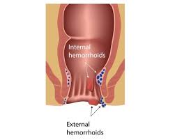 Image result for hemorrhoids