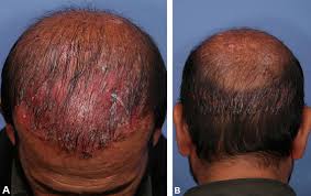 Image result for koebner phenomenon psoriasis