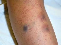 Check spelling or type a new query. Immune Thrombocytopenia Itp What Happens After Diagnosis