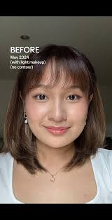 Hifu Before and After Kl