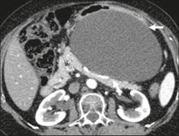 We did not find results for: Scielo Brasil Practical Approach To Primary Retroperitoneal Masses In Adults Practical Approach To Primary Retroperitoneal Masses In Adults