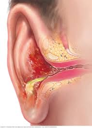 In addition, a perforated eardrum may cause bleeding. Swimmer S Ear Symptoms And Causes Mayo Clinic
