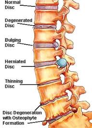 Degenerative Disc Disease Spinal Arthritis Herniated Disc Degenerative Disc Disease