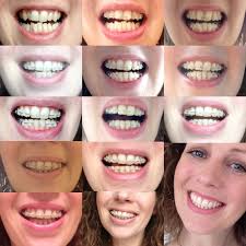 Smile Transformation The Braces Are Off Teeth Braces Clear Braces Teeth Damon Braces