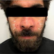 PDF) Post-orthognathic surgical ciliated cyst of the anterior maxilla: a  case report and narrative review