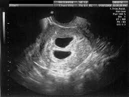 Transvaginal Ultrasound During Pregnancy
