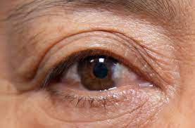 Que Es Una Carnosidad Shepard Eye Center