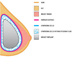 If a guy really loves you he will accept you for who you are. Bia Alcl 5 Questions And Answers About A Cancer Linked To Breast Implants Cancer Plastic Surgery Ut Southwestern Medical Center