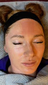 Microneedling with PRF is spectacular! Check out Jocassee Hydration and  Aesthetics in Downtown Seneca! , #lookyounger #prf #Microneedling